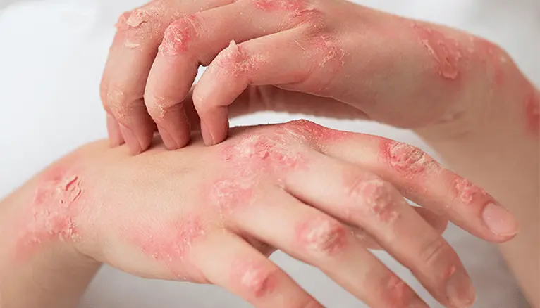 Understanding Eczema: Why Most Treatments Fail